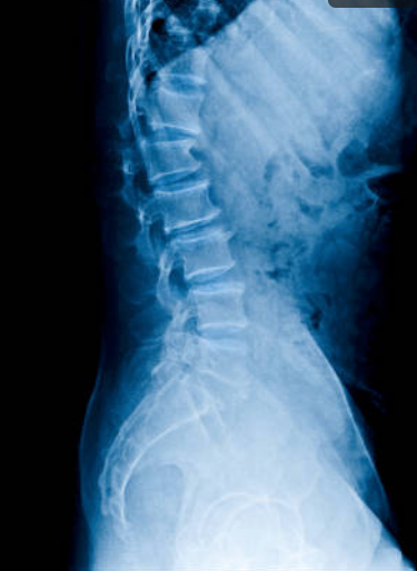 Hernia Discal Cervical