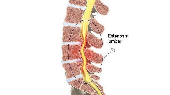 estenosis de canal lumbar patología de la columna vertebral