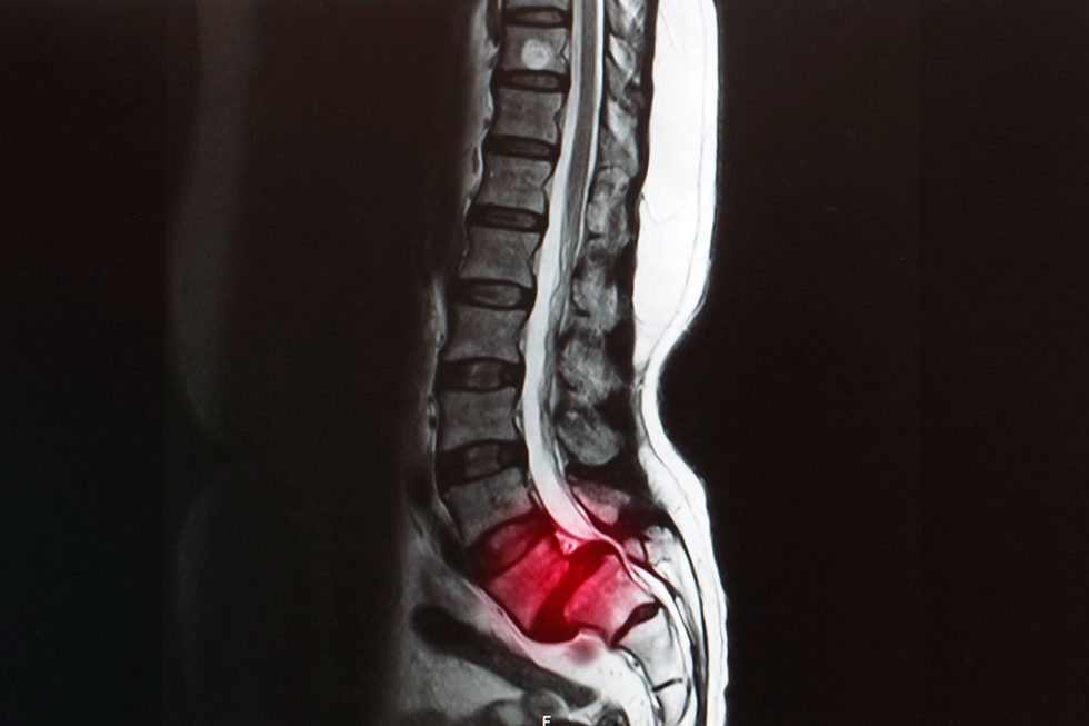 Espondilolistesis | Patología De La Columna Vertebral