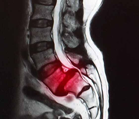 Espondilolistesis