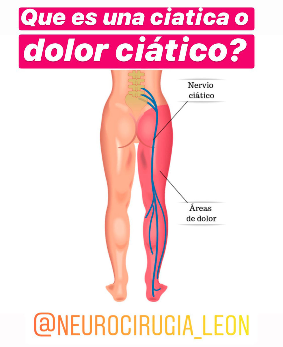 Ciática O Dolor Ciático Lumbociática Doctor Valle Folgueral