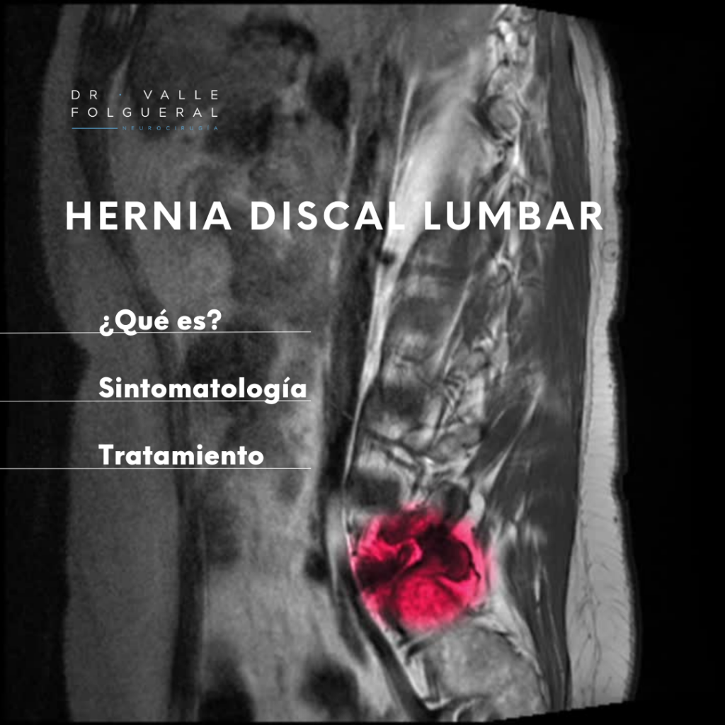 HERNIA DISCAL LUMBAR