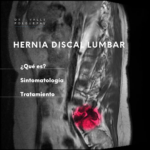 Hernia Discal Lumbar
