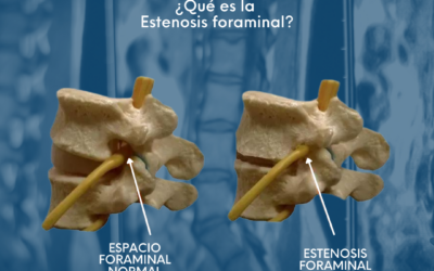 ¿Qué es la estenosis foraminal?