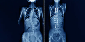 ESCOLIOSIS 1407150974