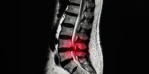 Estenosis de canal lumbar