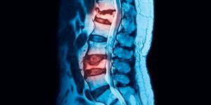 FRACTURAS OSTEOPORÓTICAS