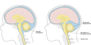 Malformacion de Chiari